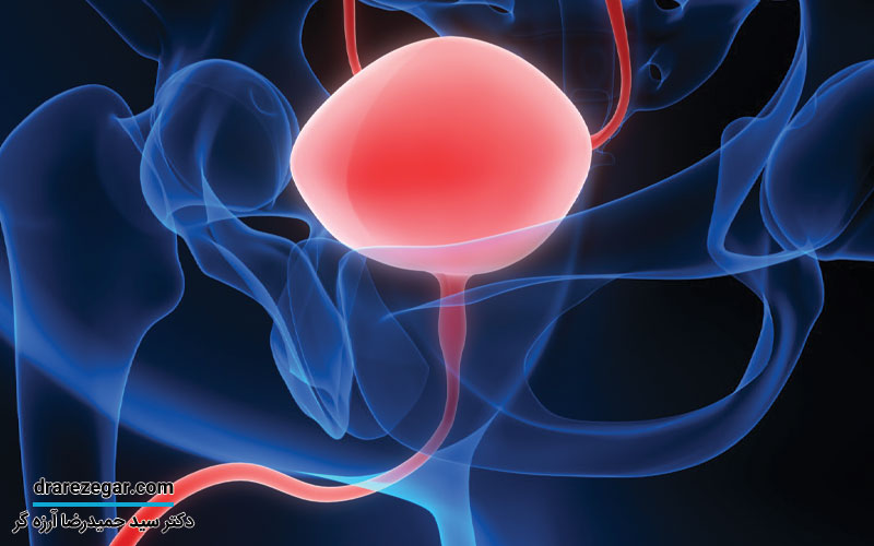 انواع سرطان مثانه چیست