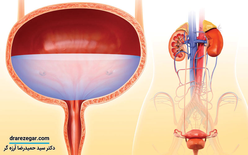 انواع سرطان مثانه چیست
