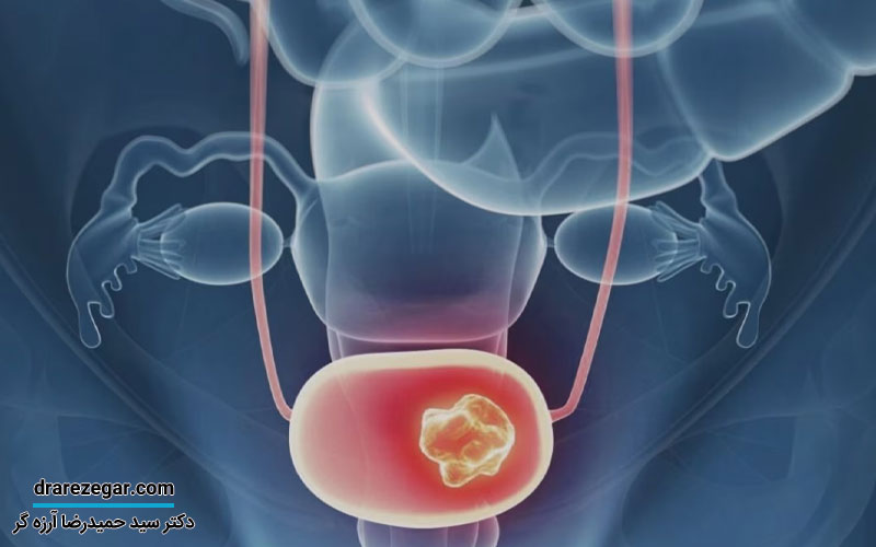 انواع سرطان مثانه چیست