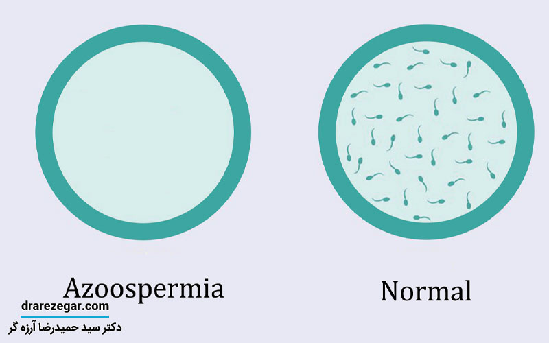 آزواسپرمی چیست