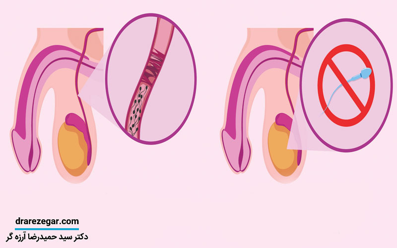 آزواسپرمی چیست