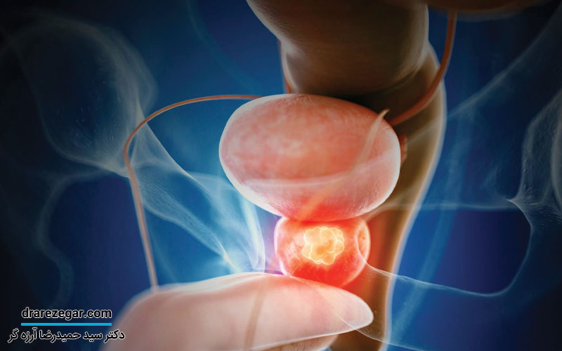 درمان پروستات به چه صورت است