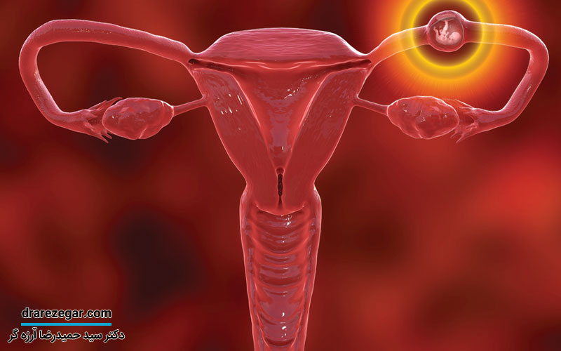 نابجایی لگنی کلیه چیست