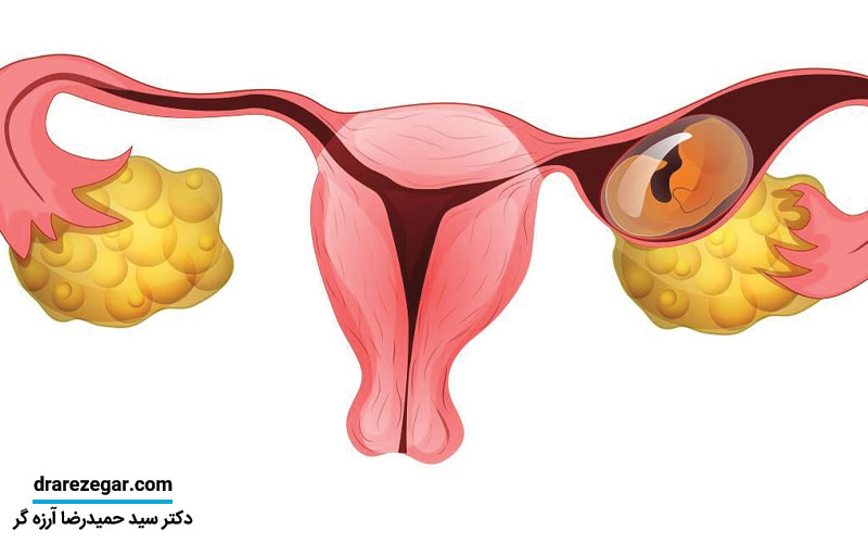 نابجایی لگنی کلیه چیست