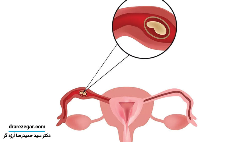نابجایی لگنی کلیه چیست