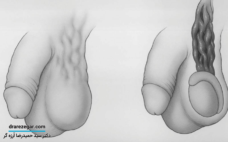 واریکوسل چیست