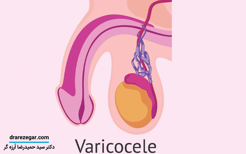 واریکوسل چیست