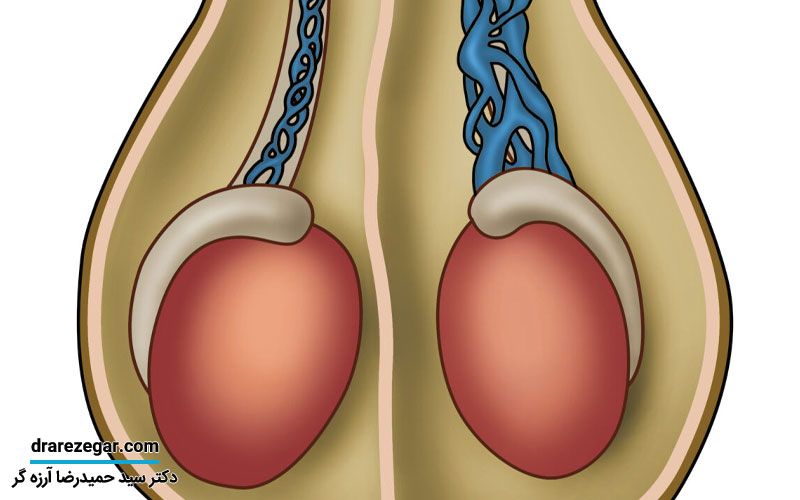 واریکوسل چیست