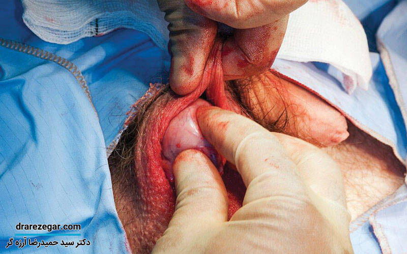 درمان کیست اپیدیدیم