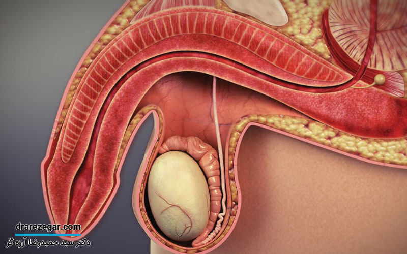 کجی آلت و درمان آن