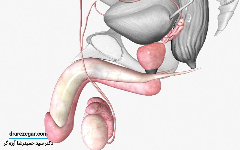 کجی آلت و درمان آن