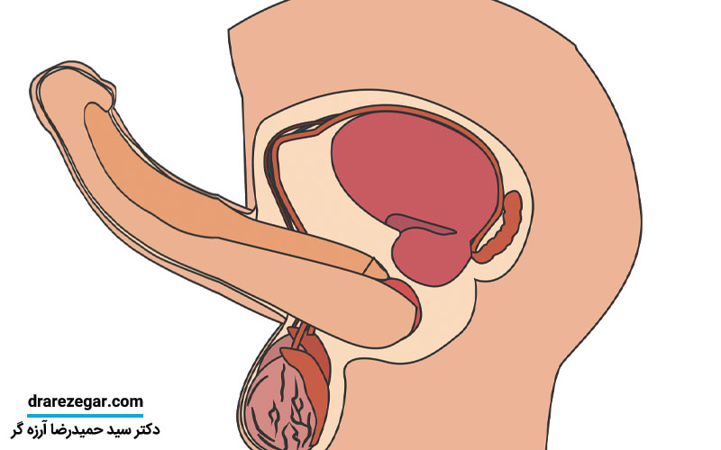 کجی آلت و درمان آن