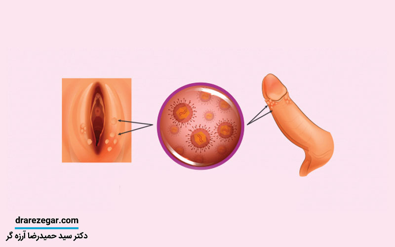 انواع بیماری های آلت تناسلی