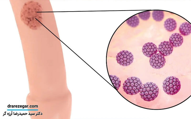 انواع بیماری های آلت تناسلی