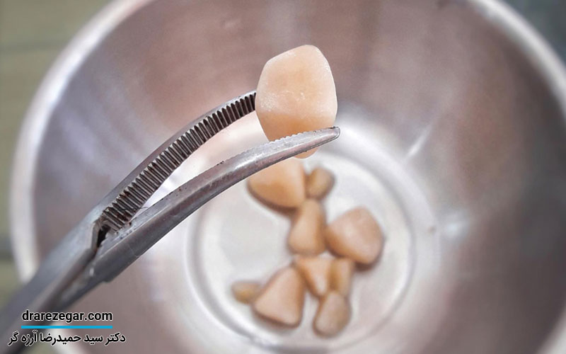 درمان سنگ مثانه