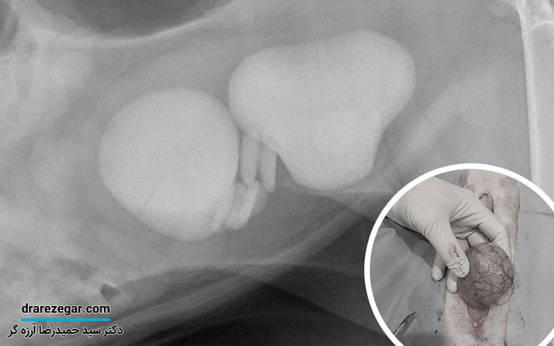 درمان سنگ مثانه