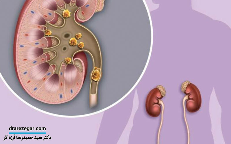 درمان سنگ مثانه