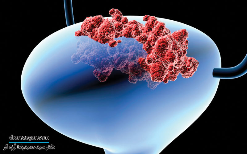 سرطان های دستگاه تناسلی ادراری