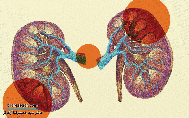 نشانه های نارسایی کلیه