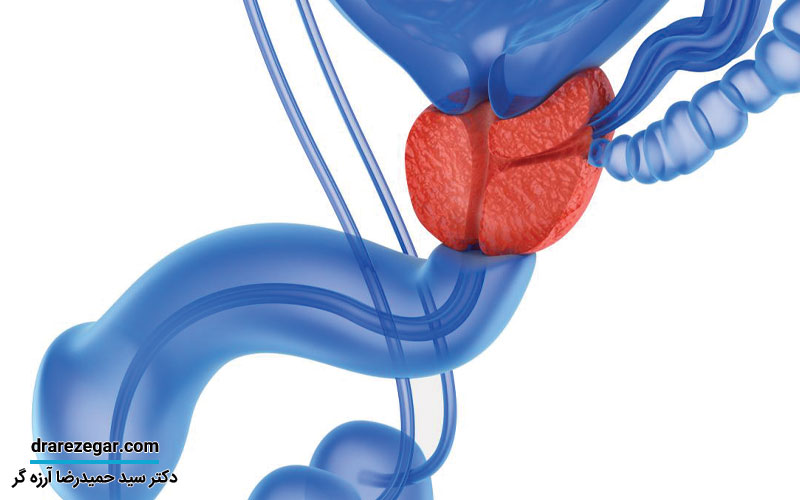 بزرگی بدخیمی پروستات