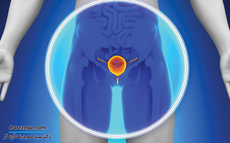 بزرگی بدخیمی پروستات