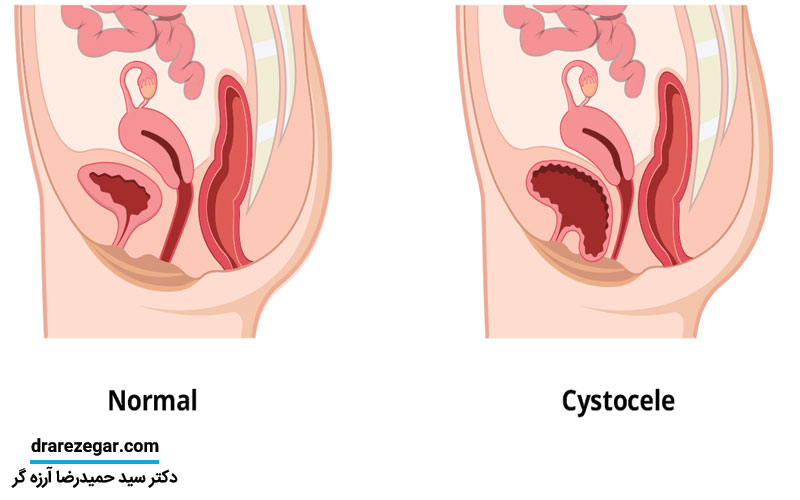 سیستوسل چیست