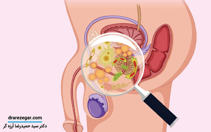 درباره التهاب پروستات بدانید