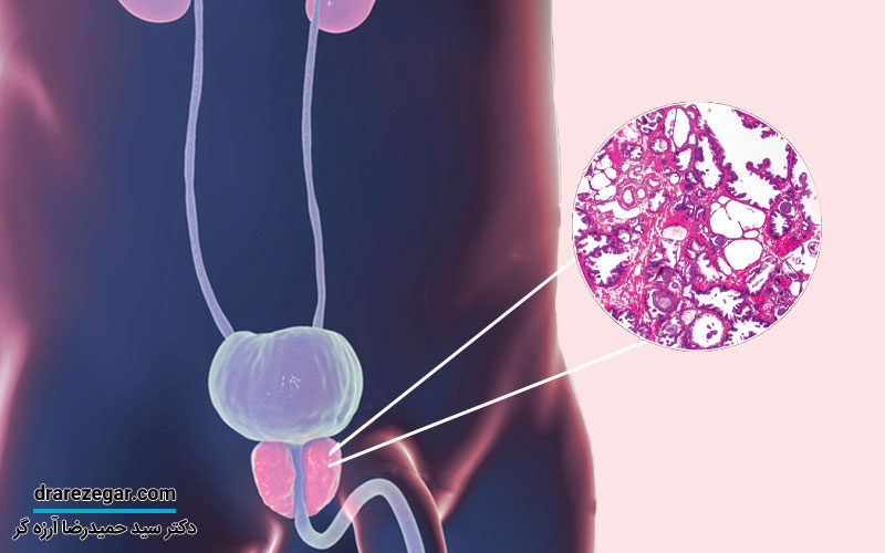 درمان پروستات با اصلاح سبک زندگی