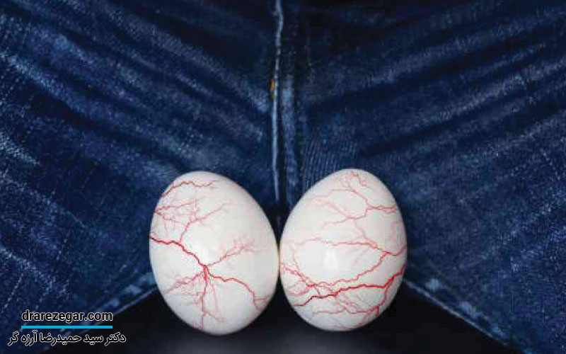 درمان ورم رگ های بیضه