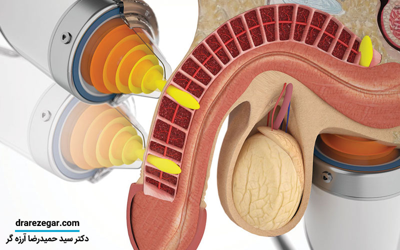 درمان نعوظ با شاک ویو تراپی
