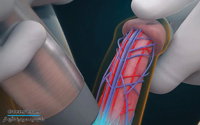 درمان نعوظ با شاک ویو تراپی