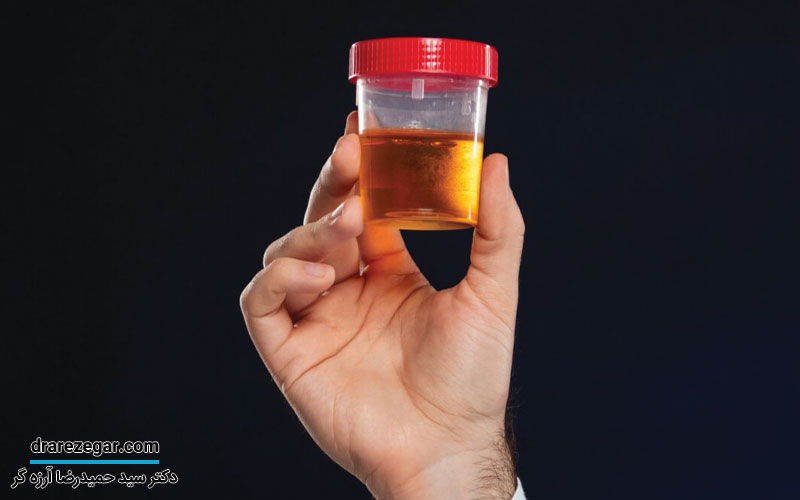 دلایل ادرار خونی در مردان