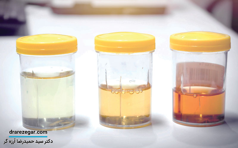 دلایل ادرار خونی در مردان