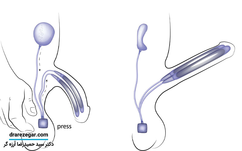 جراحی پروتز آلت تناسلی در مردان