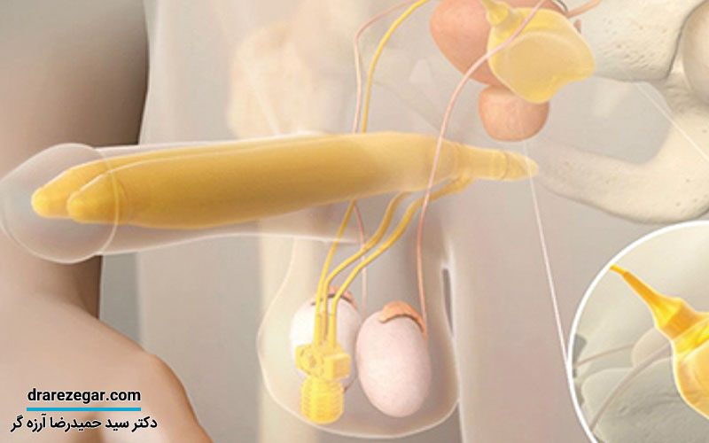 جراحی پروتز آلت تناسلی در مردان