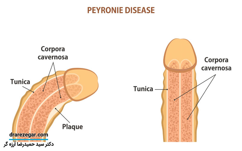 علائم بیماری پلاک پیرونی
