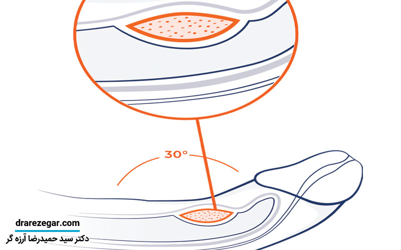 علائم بیماری پلاک پیرونی