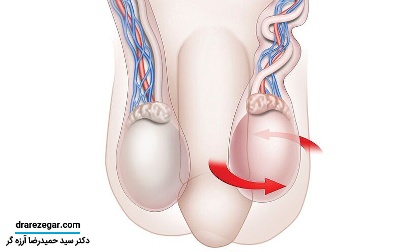 پیچ خوردگی بیضه ها