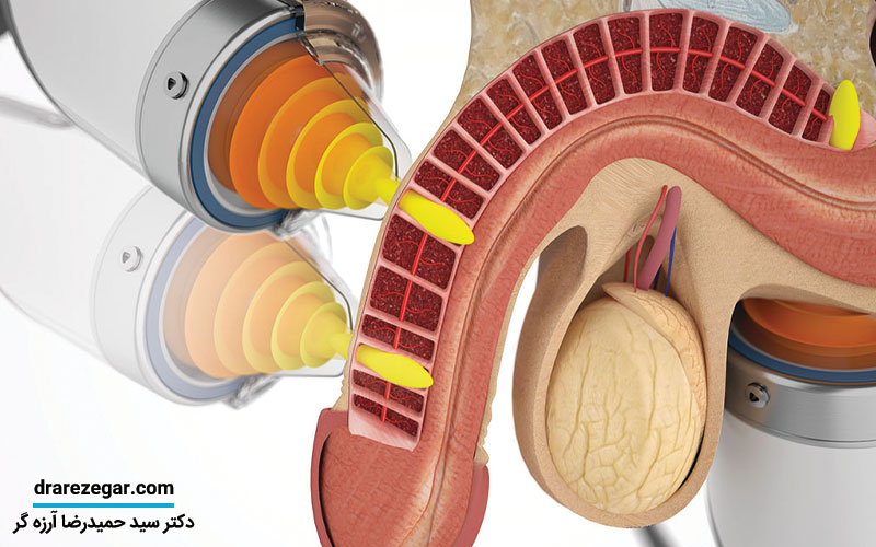 شاک ویوتراپی برای درمان اختلال نعوظ
