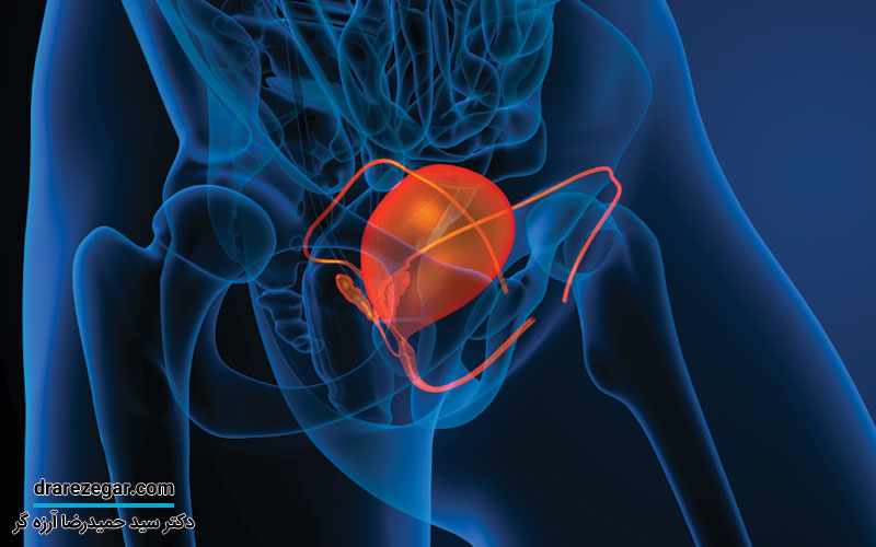 درباره مثانه نوروژنیک باید بدانید