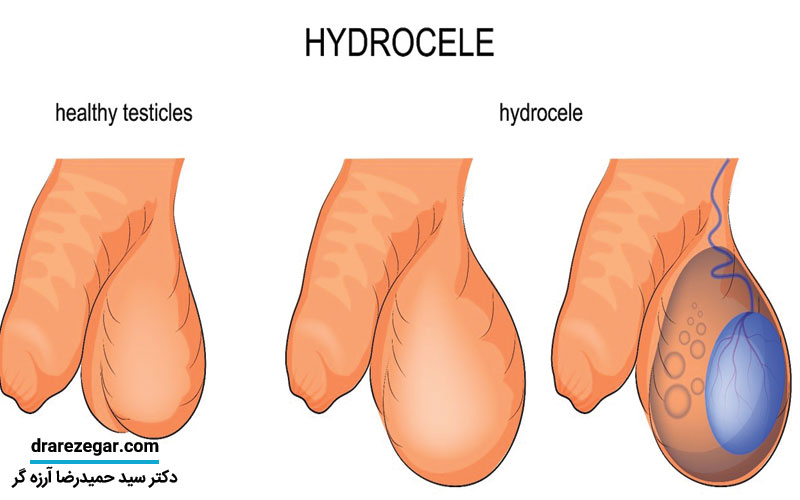 هیدروسل چگونه باعث ورم بیضه می شود