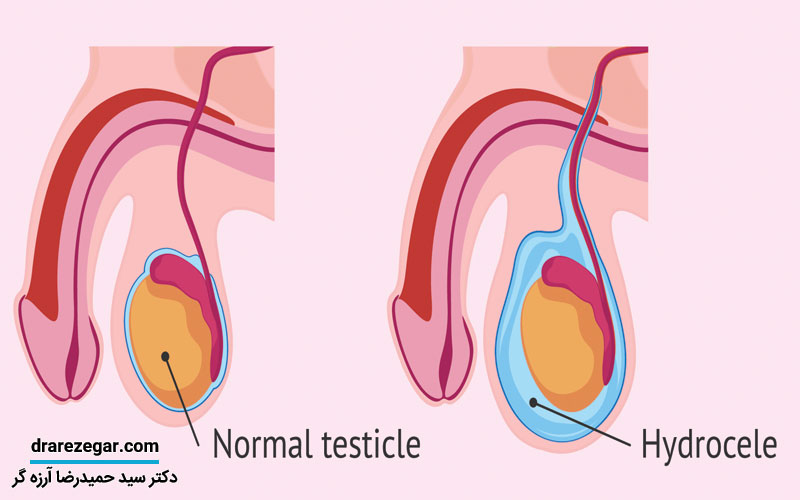 هیدروسل چگونه باعث ورم بیضه می شود