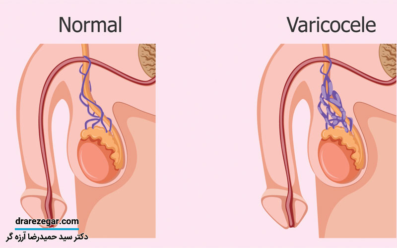 آیا واریکوسل حتما باید جراحی شود