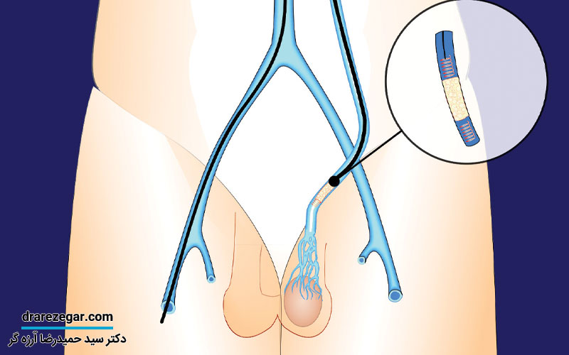 آیا واریکوسل حتما باید جراحی شود