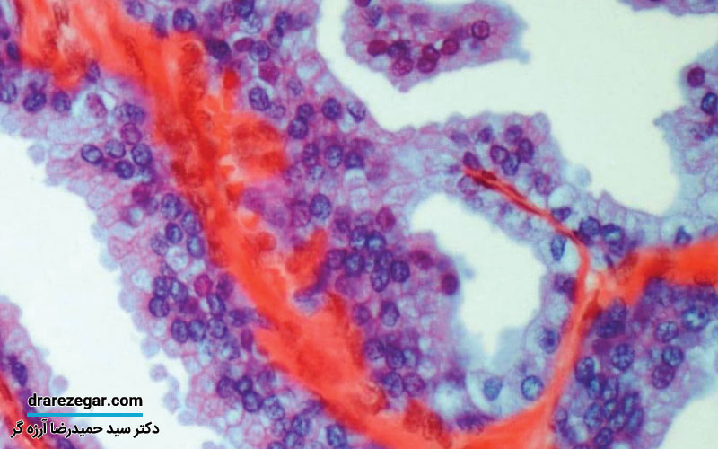 علت خونریزی بعد از جراحی پروستات