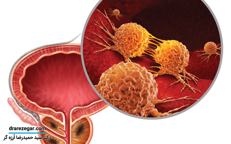 درمان بزرگی پروستات با طب سنتی امکان پذیر است