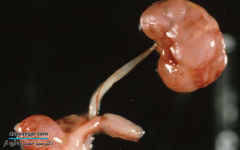 دیسپلازی کلیه در کودکان