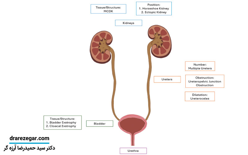 دیسپلازی کلیه در کودکان