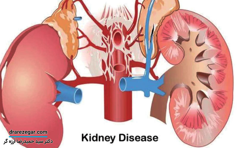 روش تشخیص انواع بیماری کلیوی