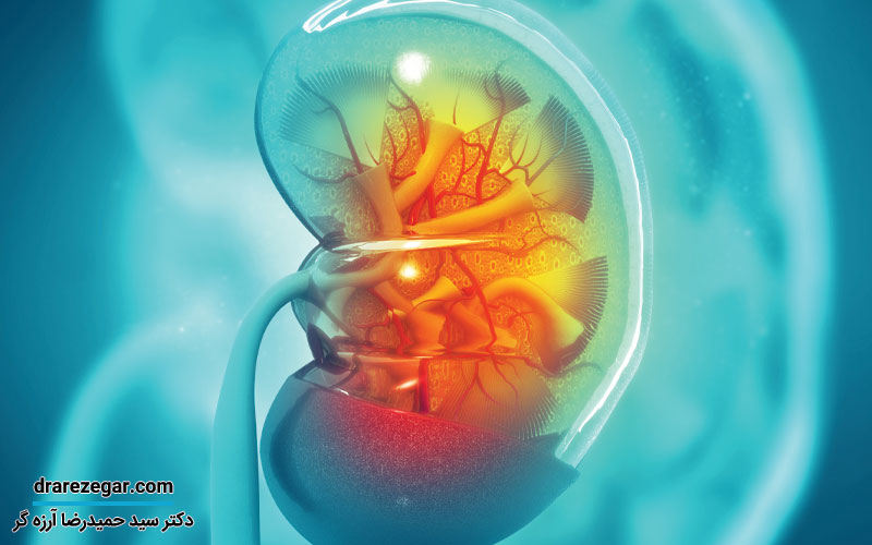 مراقبت های پس از جراحی سنگ کلیه در حالب